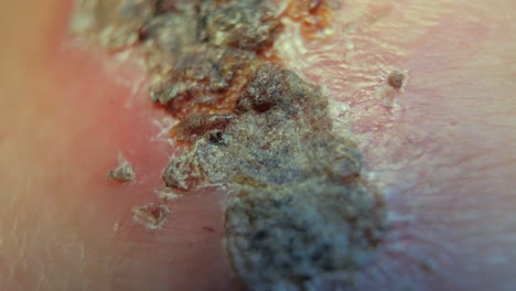A-macro-shot-of-a-scab-on-a-knee
