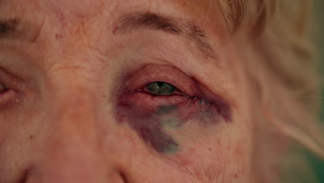 Close-up-on-elderly-female-black-eye-trauma-damage-injury-looking-at-camera