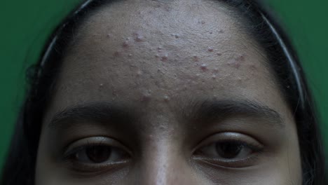 View-Of-Female-Teenager's-Forehead-With-Acne