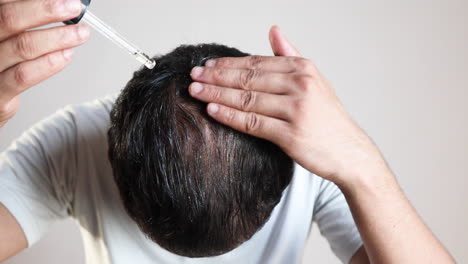 Minoxidil,-Haarserum,-Mann-Mit-Einer-Pipette-Tragen-ätherisches-Haaröl-Auf-Den-Kahlen-Bereich-Auf,-Um-Das-Haarwachstum-Auf-Weißem-Hintergrund-Zu-Fördern