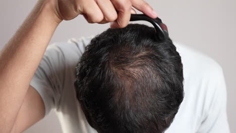 Microneedling-Haarausfallbehandlung-Für-Kahle-Kopfhaut-Zum-Nachwachsen-Der-Haare-Mit-Dermaroller,-Kollagen-Induktionstherapie
