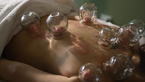 Woman-Laying-On-Stomach-With-Cupping-Therapy-Suction-Cups-Attached-On-Her-Back