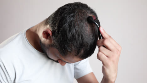 Mann-Mit-Dermaroller-Auf-Kahlen-Stellen-Für-Haarwuchs-Auf-Weißem-Hintergrund,-Behandlung-Von-Haarausfall-Bei-Männern