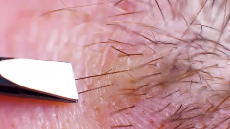 4K-Super-macro-shot-of-hair-removal-with-tweezers,-on-a-caucasian-person,-at-an-extreme-close-up,-in-a-studio