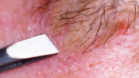 4K-Super-macro-shot-of-hair-removal-with-tweezers,-on-a-caucasian-person,-at-an-extreme-close-up,-in-a-studio