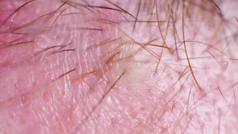 4K-Super-macro-shot-of-hair-removal-with-tweezers,-on-a-caucasian-person,-at-an-extreme-close-up,-in-a-studio