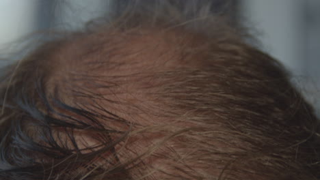 Close-up-of-a-man's-balding-head