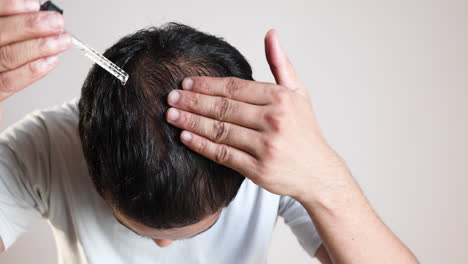 Mann,-Der-Minoxidil-Auf-Kahler-Kopfhaut-Verwendet,-Um-Haarausfall-Zu-Behandeln,-ätherisches-Haaröl-Für-Androgene-Alopezie
