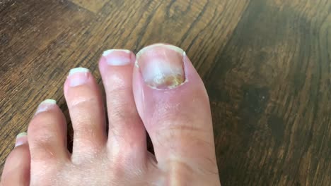 Toenail-fungus-medication-foot-doctor-men's-foot-and-toe