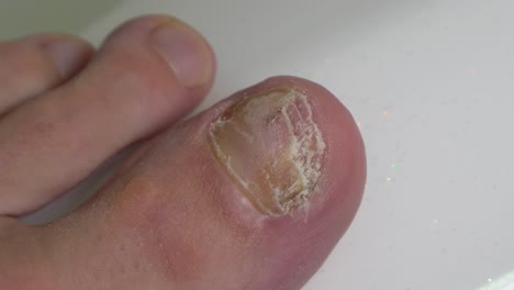 Yellow-cracked-and-discolored-toe-nail-caused-by-mycosis---fingers-rub-the-sore-toe,-close-up