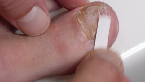 Scraping-Big-Toe-Nail-Infected-With-Mycosis-Fungal-Infection
