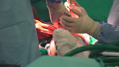 El-Reemplazo-De-Cadera-Es-Un-Procedimiento-Quirúrgico-En-El-Que-Se-Reemplaza-La-Articulación-De-La-Cadera-Por-Un-Implante-Protésico,-Es-Decir,-Una-Prótesis-De-Cadera