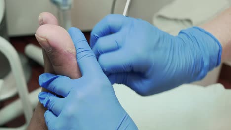 Podiatry-cutting-dead-skin-and-calluses-on-the-sole-of-the-left-foot