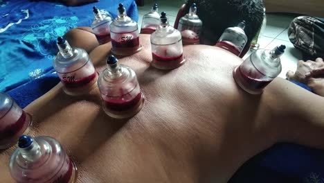 Cupping-or-Bekam-Hijamah-is-traditional-treatment