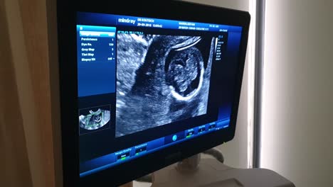 Fetaler-Ultraschallbildschirm,-Der-Das-Baby-Im-Mutterleib-Zeigt