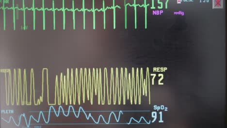 Un-Monitor-Cardíaco-Del-Hospital-Monitorea-A-Un-Bebé-Dentro-De-Su-Madre-Embarazada-Que-Actualmente-Está-En-Trabajo-De-Parto