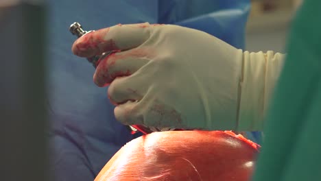 El-Reemplazo-De-Rodilla-Es-Un-Procedimiento-Quirúrgico-En-El-Que-Se-Reemplaza-La-Articulación-De-La-Rodilla-Por-Un-Implante-Protésico,-Es-Decir,-Una-Prótesis-De-Rodilla.