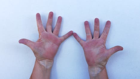 A-middle-aged-woman-with-skin-condition-of-vitiligo