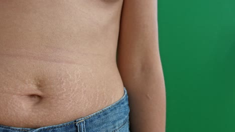 Close-up-on-woman-belly-with-stretch-marks-on-the-skin-after-child-birth