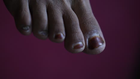 -View-Of-Toes-Of-Right-Foot,-With-Dry-Skin-Of-Ethnic-Minority-Person