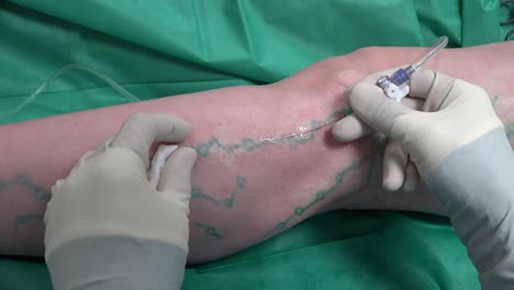 Vascular-Surgeon-is-Marking-Veins-for-Varicose-Surgery-and-Analgesia