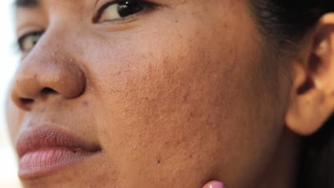 Frau-Berührt-Ihr-Gesicht-Mit-Akne
