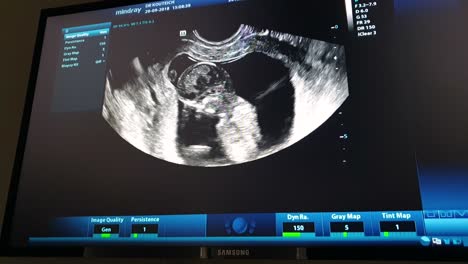 Fetaler-Ultraschallbildschirm,-Der-Das-Baby-Im-Mutterleib-Zeigt