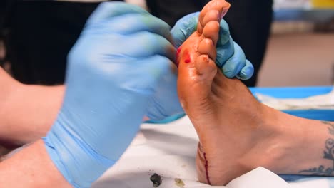 A-surgeon-or-podiatrist-performing-a-needling-procedure-on-the-verruca-on-the-sole-of-a-patient's-foot