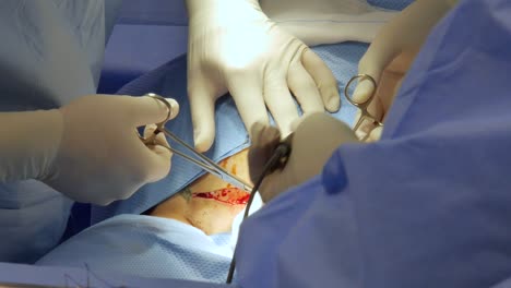 Close-up-of-doctors-performing-a-surgical-operation-on-a-patient's-abdomen-with-visible-incision-and-blood