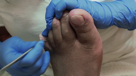 Podiatry-scraping-dead-skin-between-the-toes-of-the-left-foot