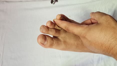 Nail-cutting-foot-with-damaged-nails-because-of-fungus