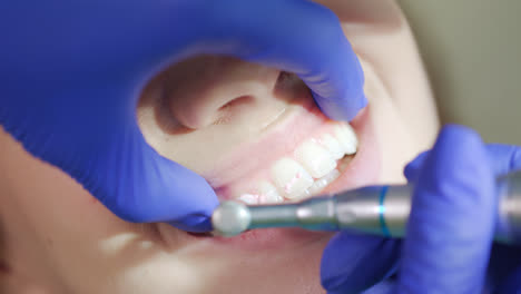 Verfahren-Zum-Polieren-Der-Zähne.-Zahnarzthände-Arbeiten-Mit-Zahnärztlichem-Hochgeschwindigkeitsbohrer