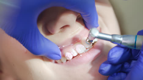 Professionelle-Entfernung-Von-Zahnbelag-In-Der-Zahnarztpraxis.-Zähne-Polieren-Aus-Nächster-Nähe
