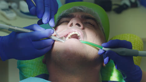 Dentist-drilling-tooth-of-patient.-Dentist-hands-working-in-open-oral-cavity