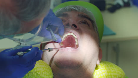 Verfahren-Zur-Entfernung-Von-Karies.-Nahaufnahme-Der-Hände-Des-Zahnarztes,-Die-Den-Kranken-Zahn-Entfernen