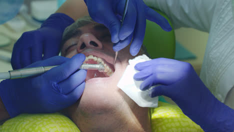 Behandlung-Von-Zahnschmerzen-In-Der-Zahnarztpraxis.-Nahaufnahme-Eines-Zahnarztes,-Der-Einen-Kranken-Zahn-Bohrt