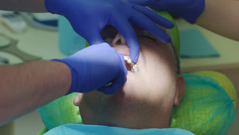 Deinstallationsprozess-Von-Zahnimplantaten.-Nahaufnahme-Der-Hände-Des-Zahnarztes-Beim-Entfernen-Der-Prothese